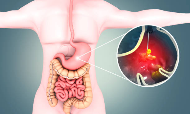 what causes stomach ulcers