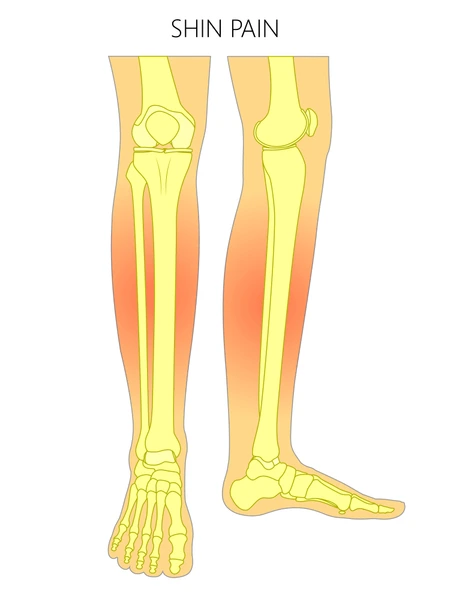 anterior compartment syndrome