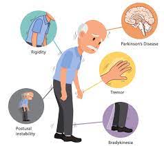 parkinsonism