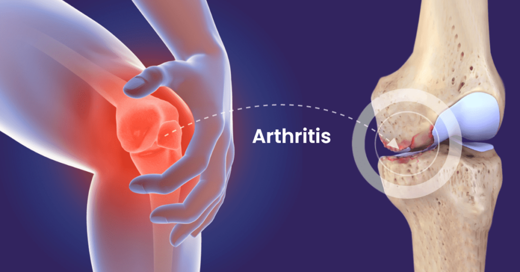 arthritis0