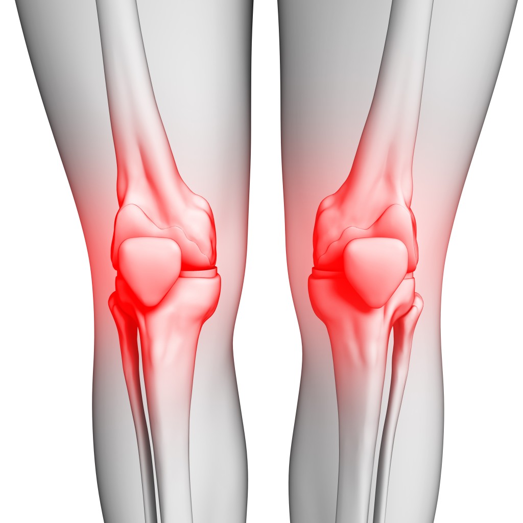 osgood schlatter's syndrome