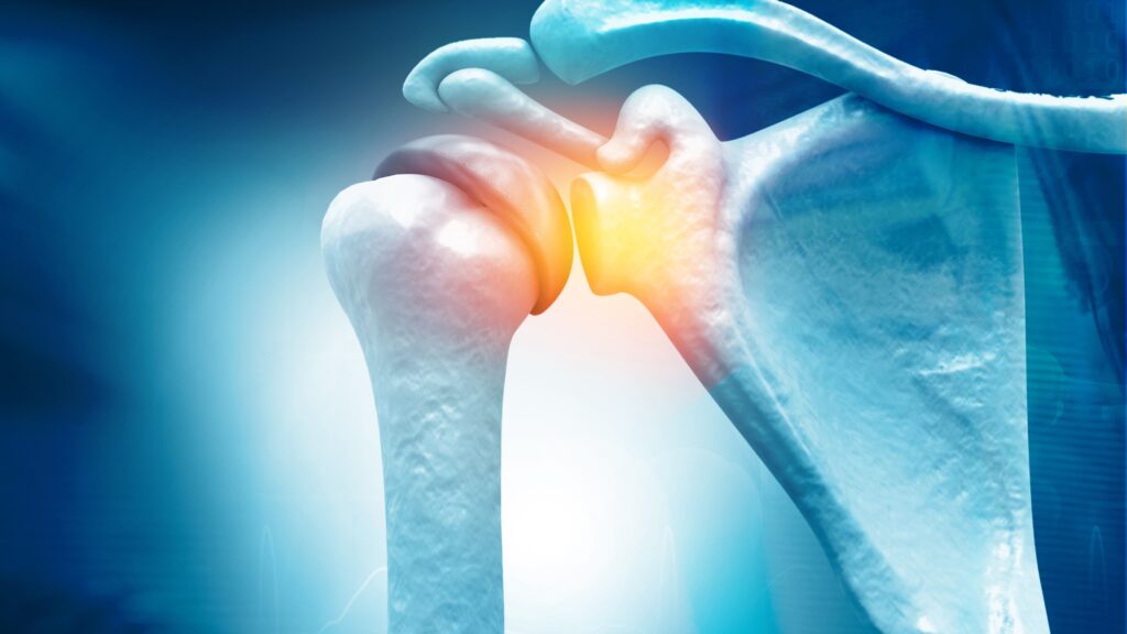 rotator cuff tear